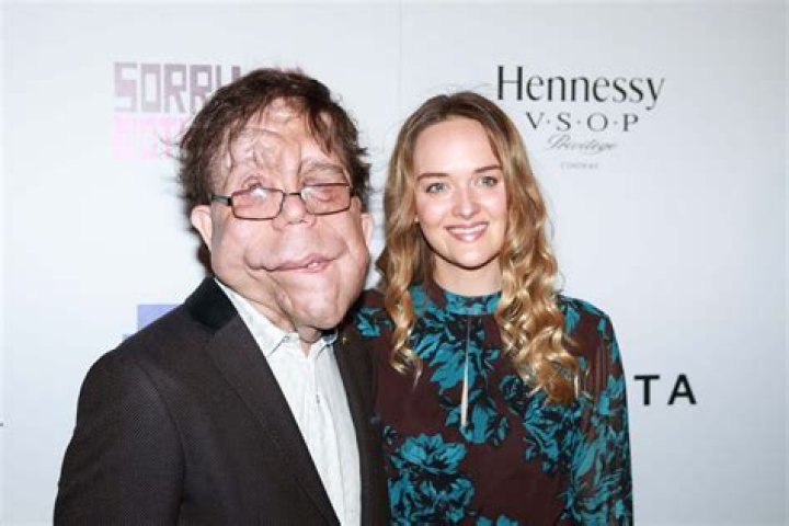 Adam Pearson Height: A Detailed Look into His Life, Career, and Influence