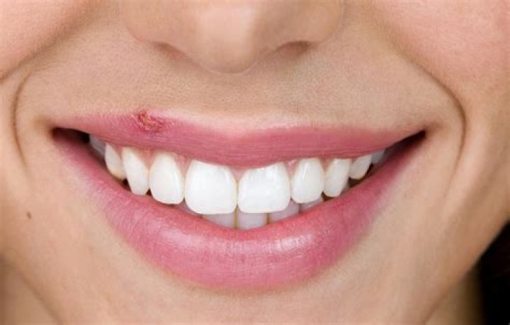 Can You Pop a Cold Sore Safely? Everything You Need to Know