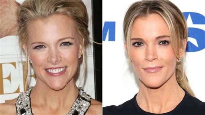 Megyn Kelly Plastic Surgery: Before & After Photos?