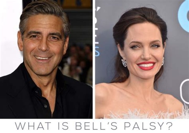 Famous Celebrities with Bell's Palsy