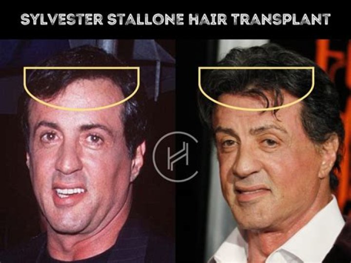 Has Sylvester Stallone Had a Stroke? Exploring the Facts and Myths