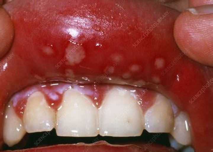 Understanding Herpes: Causes, Symptoms, and Treatment Options