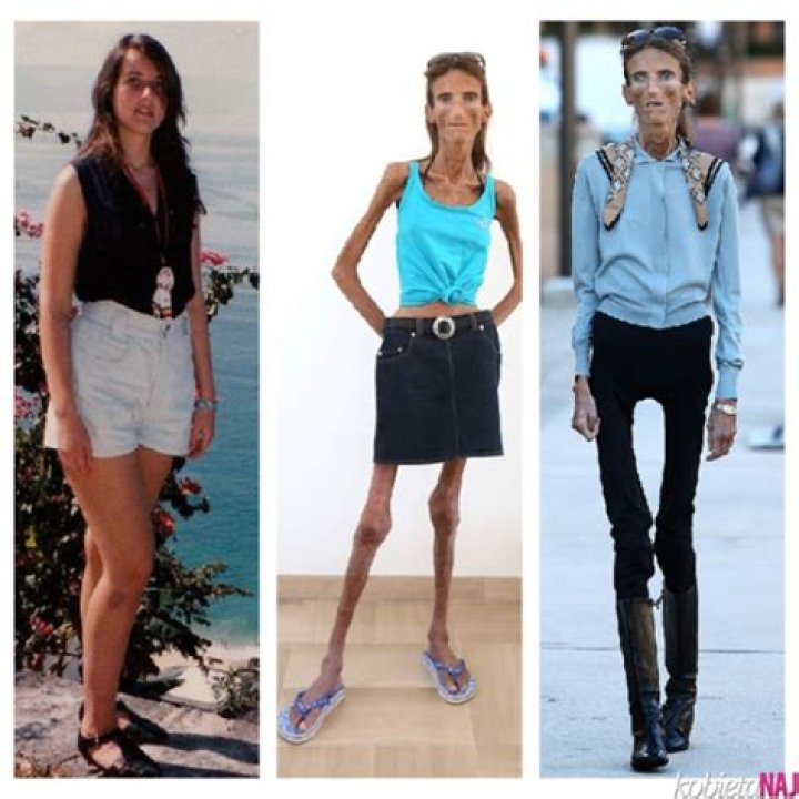 Exploring the Weight of the Skinniest Person in the World: How Much Does the Skinniest Person in the World Weigh?