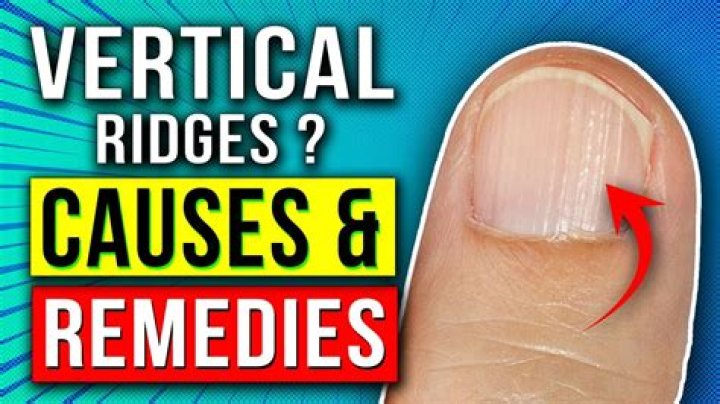 How to Get Rid of Ridges in Nails: A Comprehensive Guide for Strong and Healthy Nails