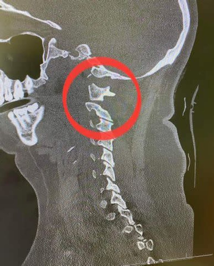 Internally Decapitated: Understanding the Rare and Complex Medical Condition