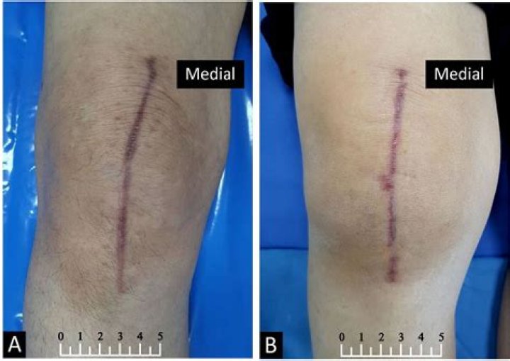 Knee Surgery Scar: Understanding, Managing, and Healing