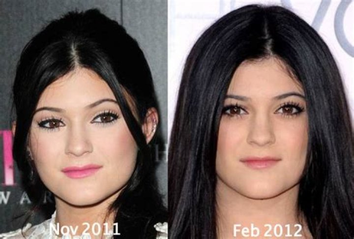 Kylie Jenner Before Plastic Surgery: A Closer Look at Her Transformation