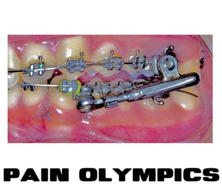 Olympic BME Pain Expert Strategies for Effective Relief
