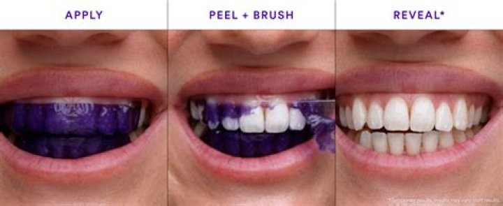 Purple Teeth Whitening: The Revolutionary Approach to Teeth Brightening