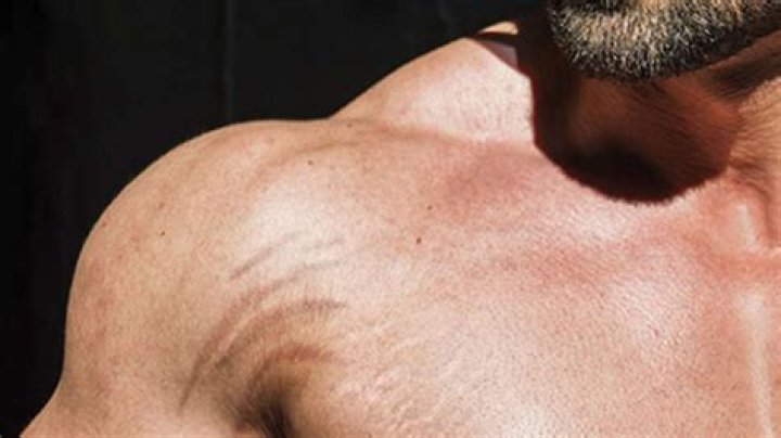 Understanding Rapid Muscle Growth Stretch Marks: Causes, Prevention, and Solutions