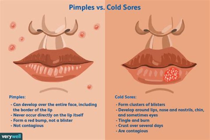 Should I Pop a Cold Sore? Everything You Need to Know