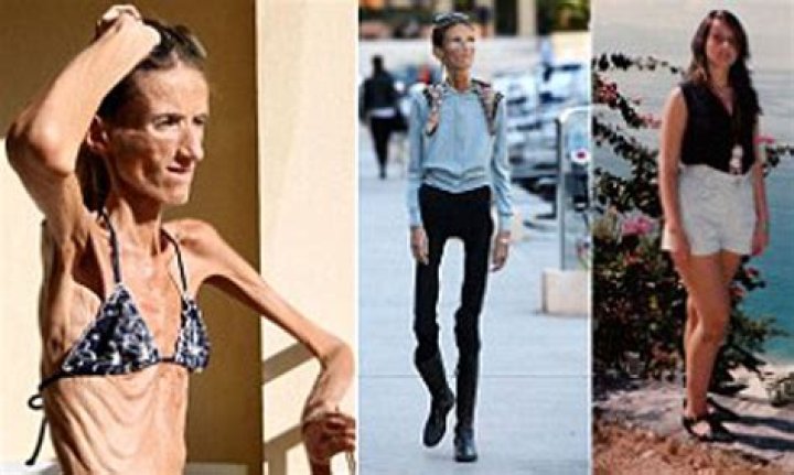 Exploring the Lives of the Skinniest People in the World: Stories, Causes, and Inspiration
