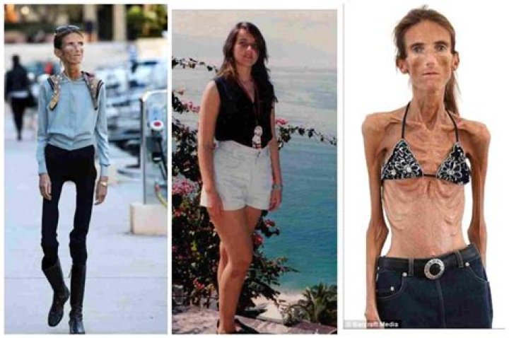 Who is the Skinniest Person in the World 2024? Unveiling the Extraordinary Story
