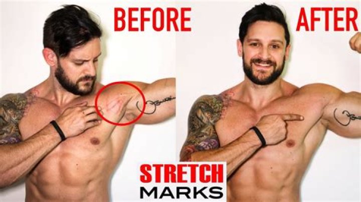 Understanding Stretch Marks and Muscle Growth: A Comprehensive Guide