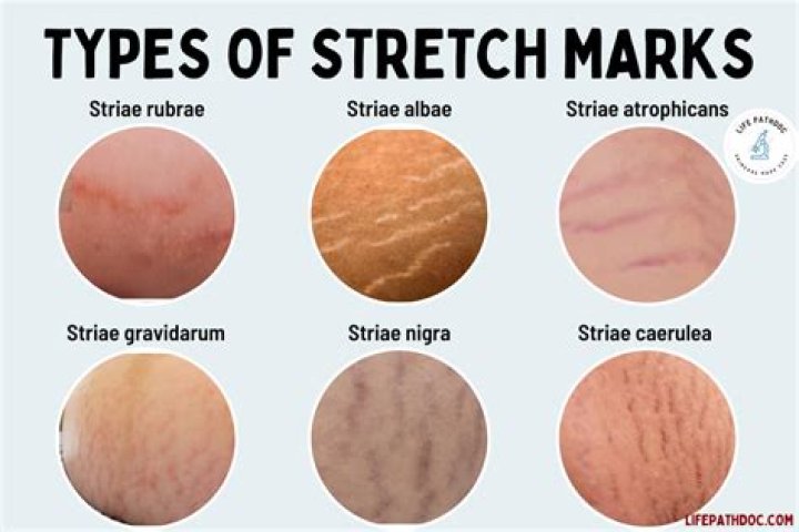 Understanding Stretch Marks: Causes, Prevention, and Treatment Options