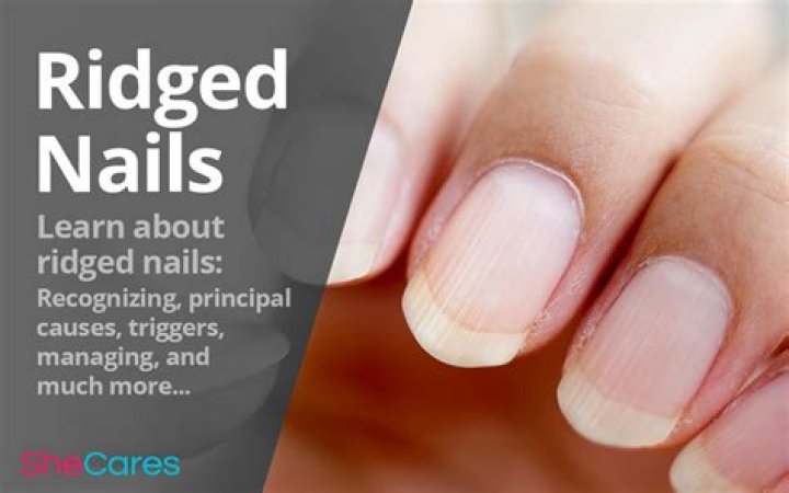 Treatment for Dry Nails with Ridges: A Comprehensive Guide to Restore Your Nail Health